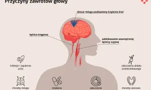Ilustracja pokazuje przyczyny zawrotów głowy, w tym problemy z krążeniem mózgowym, które mogą prowadzić do silnych zawrotów głowy.