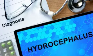 Na stole lekarskim leżą dokument z napisem "Diagnosis", stetoskop, okulary i tablet z hasłem "HYDROCEPHALUS". To zespół hakima.