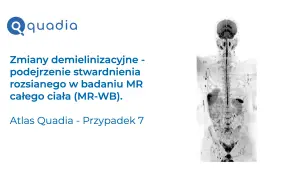 Badanie MR całego ciała wykazało zmiany demielinizacyjne, sugerujące stwardnienie rozsiane. Atlas Quadia, przypadek 7.