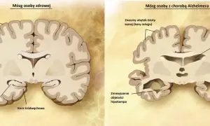 Porównanie mózgu zdrowego i z chorobą Alzheimera. Widoczne zmniejszenie hipokampa i kory mózgowej, co jest jedną z przyczyn choroby.