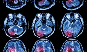 Przekroje mózgu MRI pokazujące obszary uszkodzeń, które mogą być związane z udarem mózgu. Czerwone plamy wskazują na potencjalne przyczyny udaru.