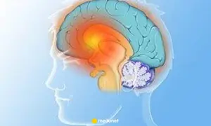 Ilustracja mózgu z zaznaczonymi obszarami, sugerującymi problemy neurologiczne, jak pląsawica choroba.