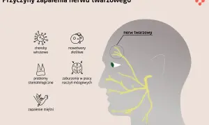 Ilustracja przedstawia schematyczne przyczyny zapalenia nerwu twarzowego: wirusy, nowotwory, problemy stomatologiczne, zaburzenia naczyń mózgowych i zapalenie mięśni.