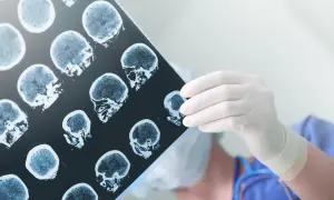 Lekarz w białej rękawiczce analizuje prześwietlenie mózgu, szukając śladów naczyniaka jamistego.