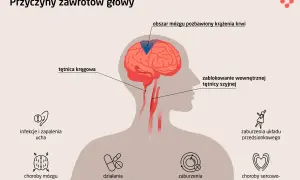Ilustracja przedstawia przyczyny zawrotów głowy: blokadę tętnicy szyjnej, problemy z krążeniem mózgu, infekcje ucha, choroby mózgu, działania niepożądane leków, zaburzenia metaboliczne, zaburzenia układu przedsionkowego i choroby sercowo-naczyniowe.