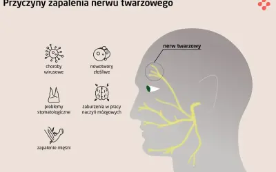 Ilustracja przedstawia schematyczne przyczyny zapalenia nerwu twarzowego: wirusy, nowotwory, problemy stomatologiczne, zaburzenia naczyń mózgowych i zapalenie mięśni.