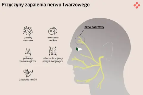 Ilustracja przedstawia schematyczne przyczyny zapalenia nerwu twarzowego: wirusy, nowotwory, problemy stomatologiczne, zaburzenia naczyń mózgowych i zapalenie mięśni.