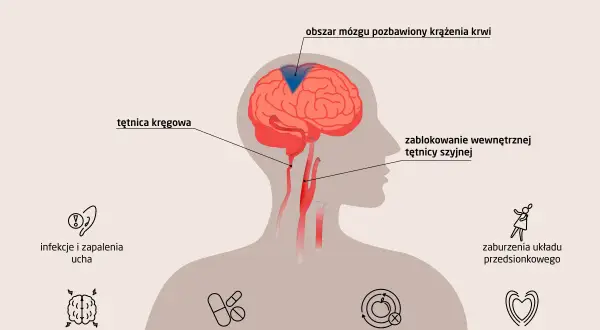 Ilustracja pokazuje przyczyny zawrotów głowy, w tym problemy z krążeniem mózgowym, które mogą prowadzić do silnych zawrotów głowy.