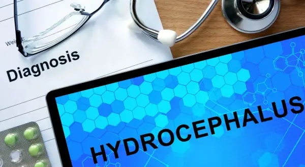 Na stole lekarskim leżą dokument z napisem "Diagnosis", stetoskop, okulary i tablet z hasłem "HYDROCEPHALUS". To zespół hakima.