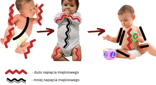 Grafika pokazuje ewolucję wzmożonego napięcia u niemowlaka: od silnego napięcia, przez zmniejszone, aż do prawidłowego.