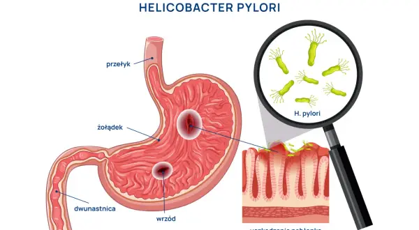 Helicobacter pylori uszkadza żołądek, powodując wrzody. Choć obraz skupia się na fizycznych objawach, warto pamiętać o potencjalnych helicobacter pylori objawy psychiczne, jak stres czy niepokój.