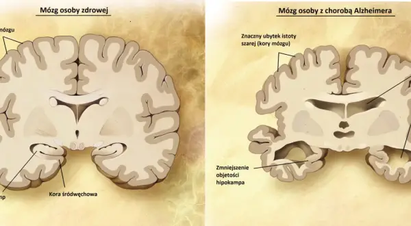 Porównanie mózgu zdrowego i z chorobą Alzheimera. Widoczne zmniejszenie hipokampa i kory mózgowej, co jest jedną z przyczyn choroby.