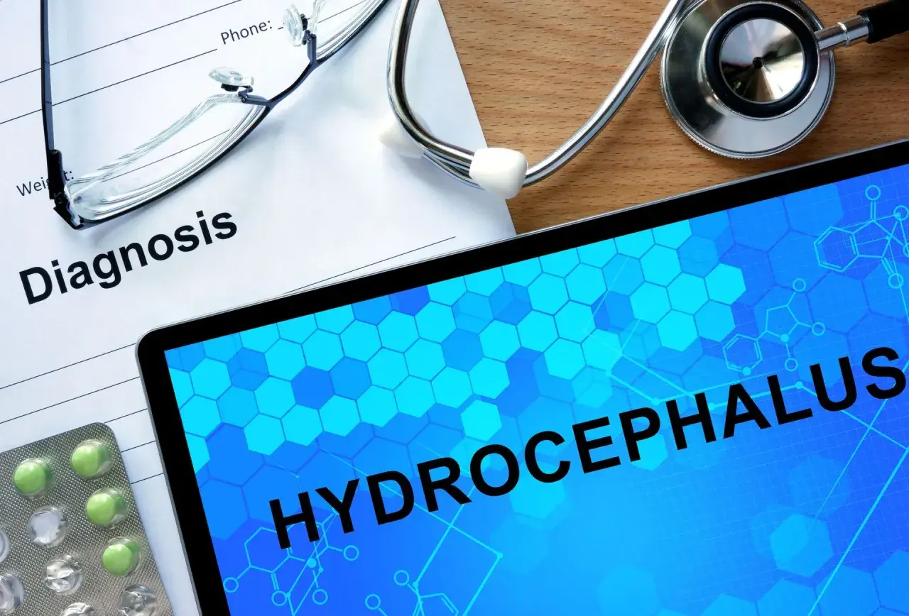 Na stole lekarskim leżą dokument z napisem "Diagnosis", stetoskop, okulary i tablet z hasłem "HYDROCEPHALUS". To zespół hakima.