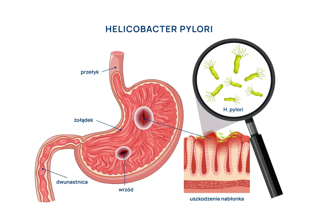 Helicobacter pylori uszkadza żołądek, powodując wrzody. Choć obraz skupia się na fizycznych objawach, warto pamiętać o potencjalnych helicobacter pylori objawy psychiczne, jak stres czy niepokój.