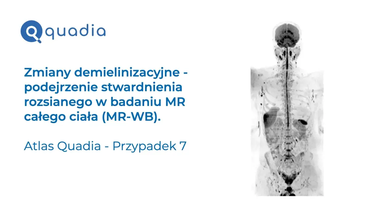 Badanie MR całego ciała wykazało zmiany demielinizacyjne, sugerujące stwardnienie rozsiane. Atlas Quadia, przypadek 7.