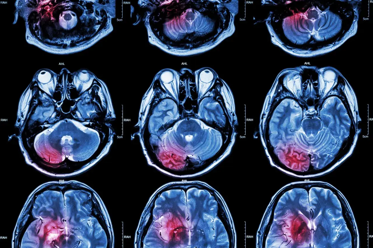 Przekroje mózgu MRI pokazujące obszary uszkodzeń, które mogą być związane z udarem mózgu. Czerwone plamy wskazują na potencjalne przyczyny udaru.