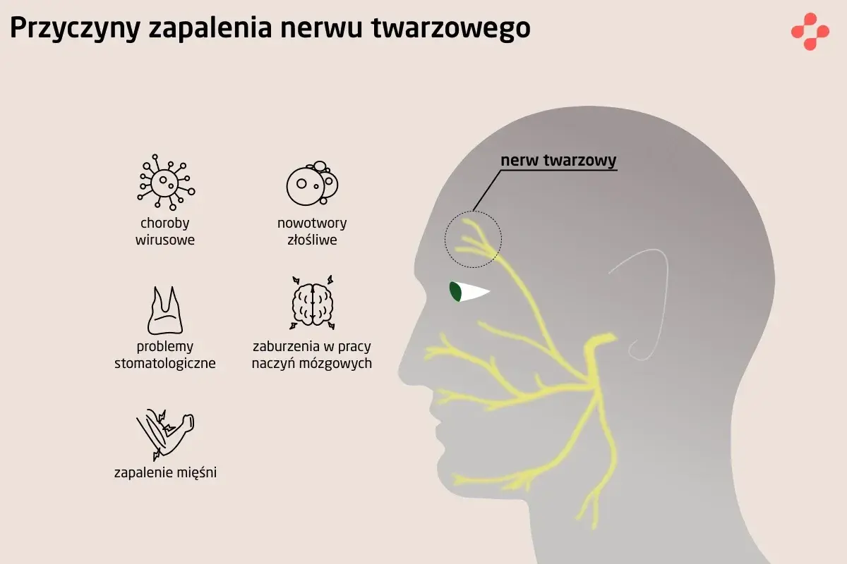 Ilustracja przedstawia schematyczne przyczyny zapalenia nerwu twarzowego: wirusy, nowotwory, problemy stomatologiczne, zaburzenia naczyń mózgowych i zapalenie mięśni.