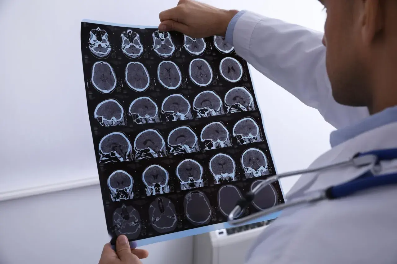 Lekarz analizuje tomografię komputerową głowy, szukając oznak krwiaka mózgu. Obraz pokazuje przekroje mózgu w różnych płaszczyznach.