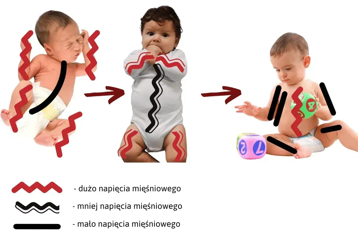 Grafika pokazuje ewolucję wzmożonego napięcia u niemowlaka: od silnego napięcia, przez zmniejszone, aż do prawidłowego.