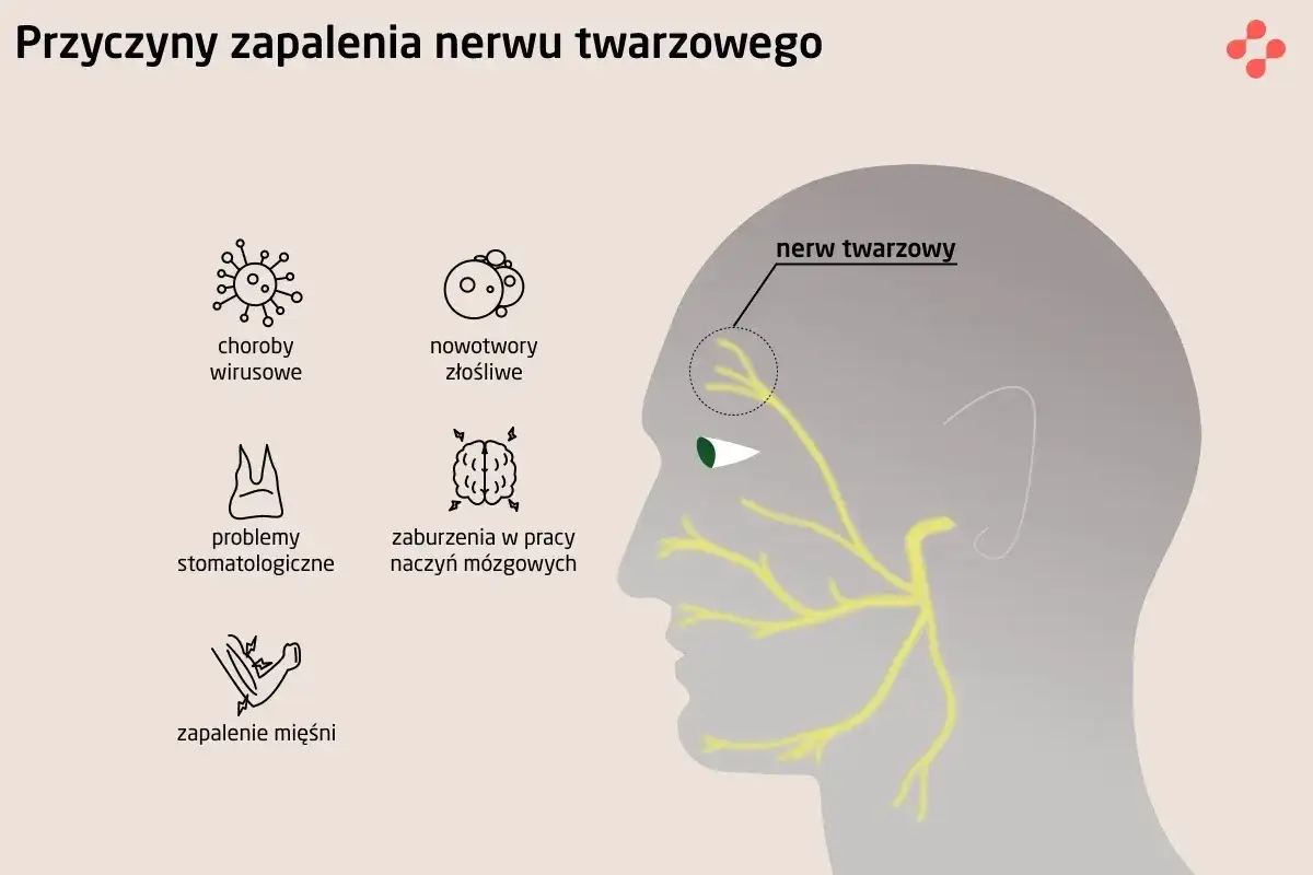 Ilustracja przedstawia schematyczne przyczyny zapalenia nerwu twarzowego: wirusy, nowotwory, problemy stomatologiczne, zaburzenia naczyń mózgowych i zapalenie mięśni.