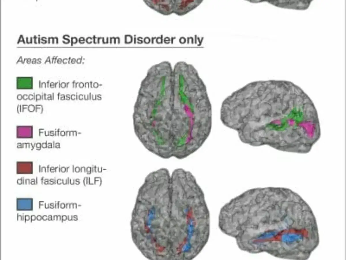 Mózg autystyczny: obszary dotknięte zaburzeniem, w tym inferior fronto-occipital fasciculus (IFOF) i fusiform-amygdala.