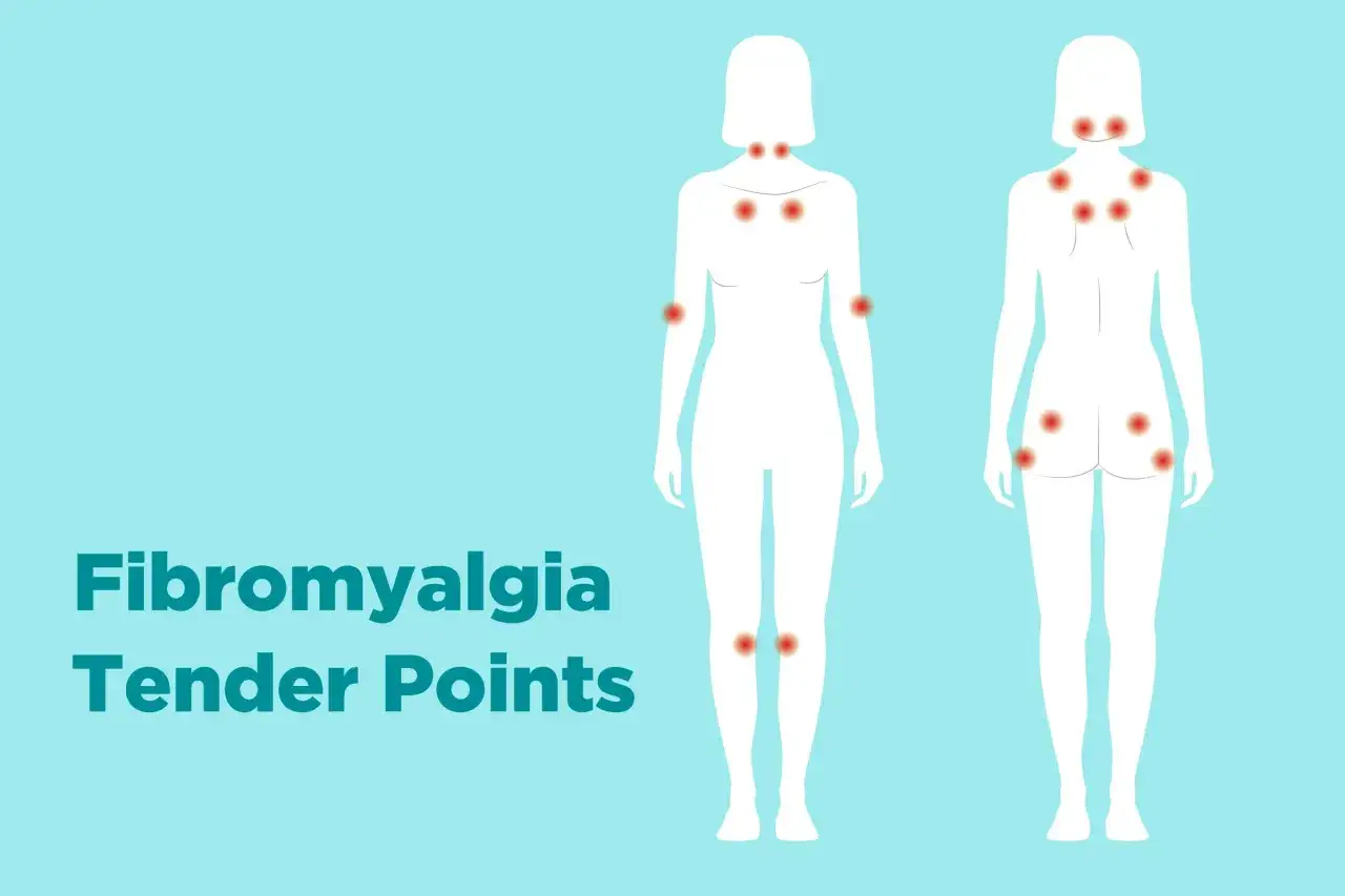Grafika pokazuje punkty b&oacute;lu związane z fibromialgią.