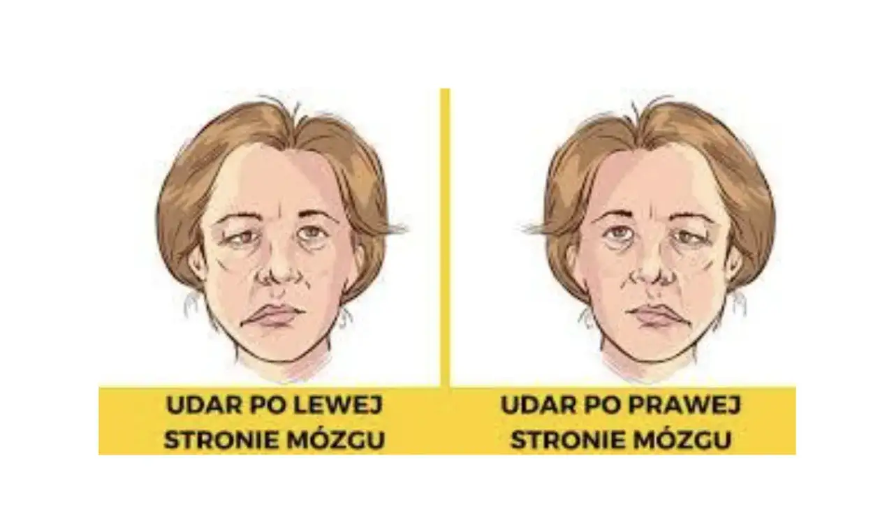 Dwie twarze z widocznymi objawami udaru. Po lewej: udar po lewej stronie mózgu. Po prawej: udar po prawej stronie mózgu.