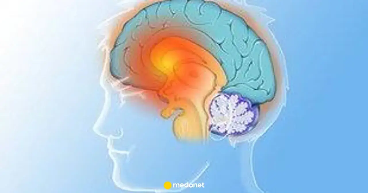 Ilustracja mózgu z zaznaczonymi obszarami, sugerującymi problemy neurologiczne, jak pląsawica choroba.