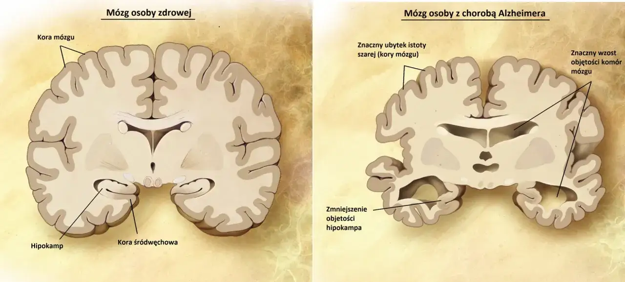 Porównanie mózgu zdrowego i z chorobą Alzheimera. Obraz pokazuje, co to demencja: ubytek kory mózgowej i zmniejszenie hipokampa.