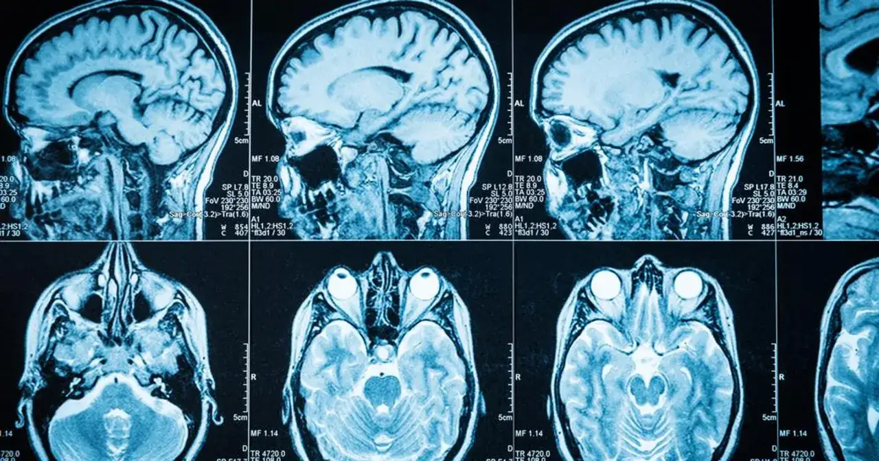 Przekroje mózgu na rezonansie magnetycznym. Widoczne są różne płaszczyzny, które mogą pomóc w diagnostyce, np. glejak objawy.