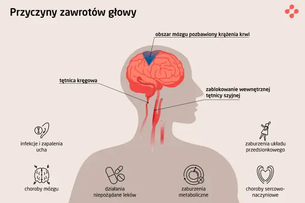 Ilustracja pokazuje przyczyny zawrotów głowy, w tym problemy z krążeniem mózgowym, które mogą prowadzić do silnych zawrotów głowy.