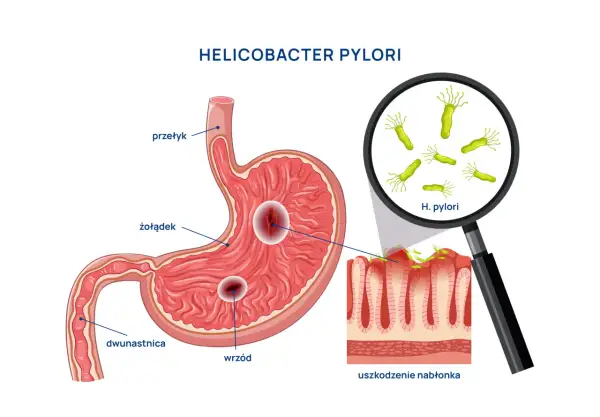 Helicobacter pylori uszkadza żołądek, powodując wrzody. Choć obraz skupia się na fizycznych objawach, warto pamiętać o potencjalnych helicobacter pylori objawy psychiczne, jak stres czy niepokój.