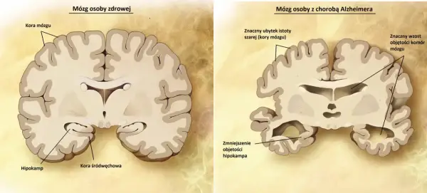 Porównanie mózgu zdrowego i z chorobą Alzheimera. Widoczne zmniejszenie hipokampa i kory mózgowej, co jest jedną z przyczyn choroby.
