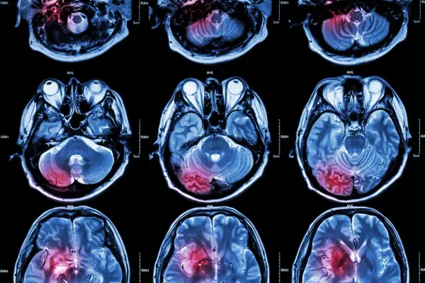 Przekroje mózgu MRI pokazujące obszary uszkodzeń, które mogą być związane z udarem mózgu. Czerwone plamy wskazują na potencjalne przyczyny udaru.
