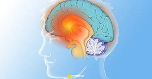 Ilustracja mózgu z zaznaczonymi obszarami, sugerującymi problemy neurologiczne, jak pląsawica choroba.