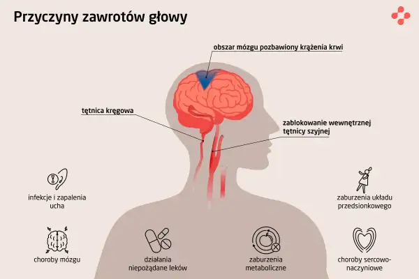Ilustracja przedstawia przyczyny zawrotów głowy: blokadę tętnicy szyjnej, problemy z krążeniem mózgu, infekcje ucha, choroby mózgu, działania niepożądane leków, zaburzenia metaboliczne, zaburzenia układu przedsionkowego i choroby sercowo-naczyniowe.